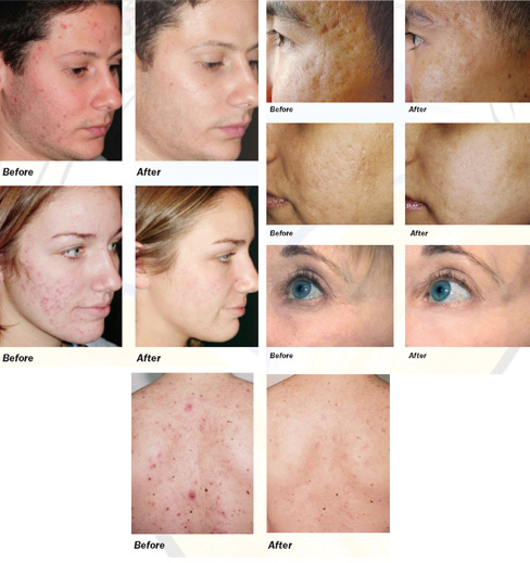 Smooth Beam Acne Treatment Before and After